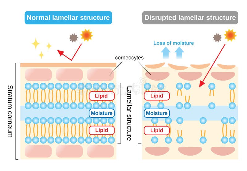 Stratum corneum, the most superficial layer of the epidermis, has a lamellar structure composed of layers of lipids and moisture. ..When it is disrupted, the skin lose its moisture, and external irritants enter the skin. Stratum corneum, the most superficial layer of the epidermis, has a lamellar structure composed of layers of lipids and moisture. ..When it is disrupted, the skin lose its moisture, and external irritants enter the skin